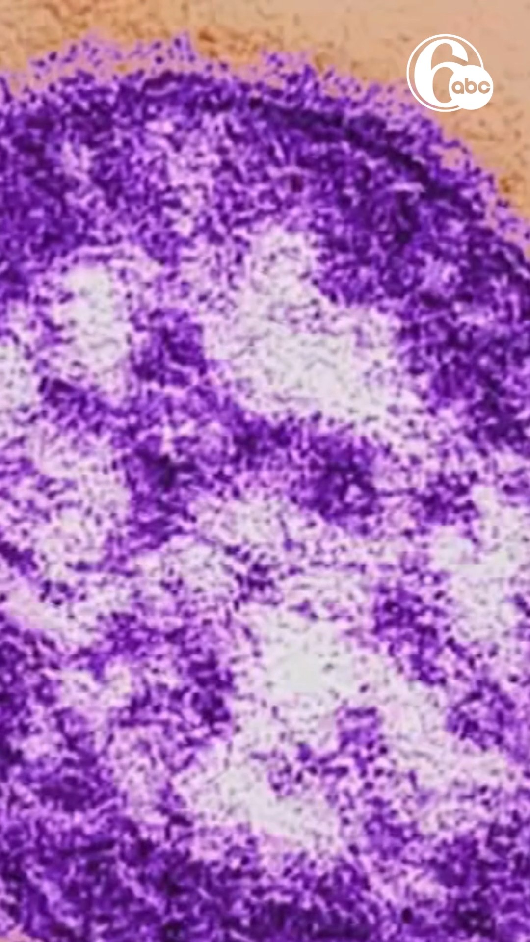 Child being treated for measles in Lehigh County, health officials say
