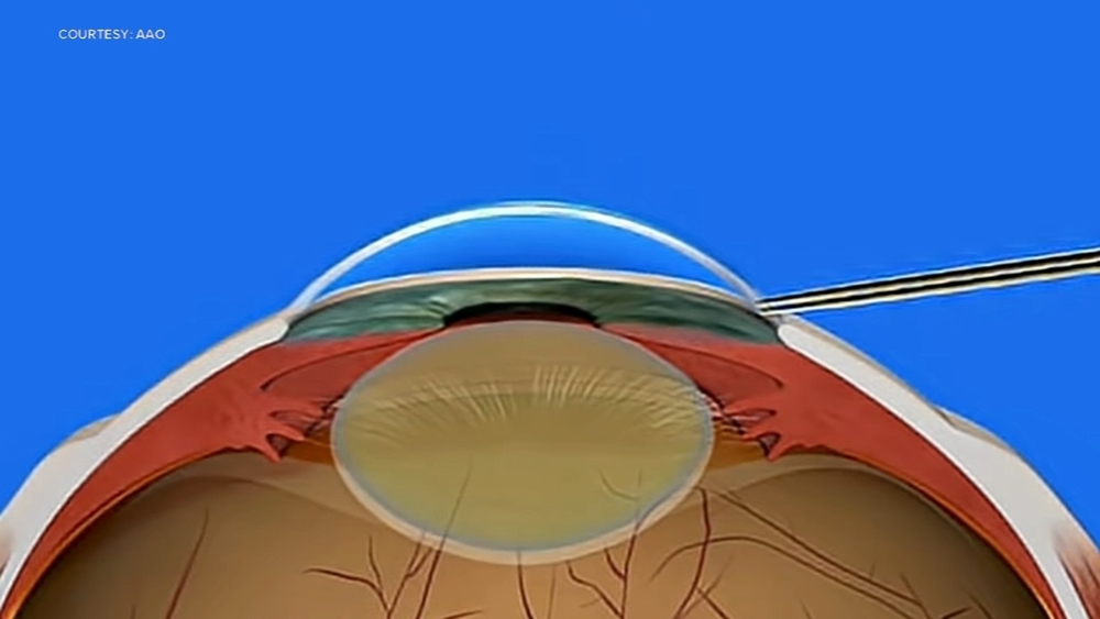 Cataract surgery reduces or eliminates need for glasses | Moves in Medicine