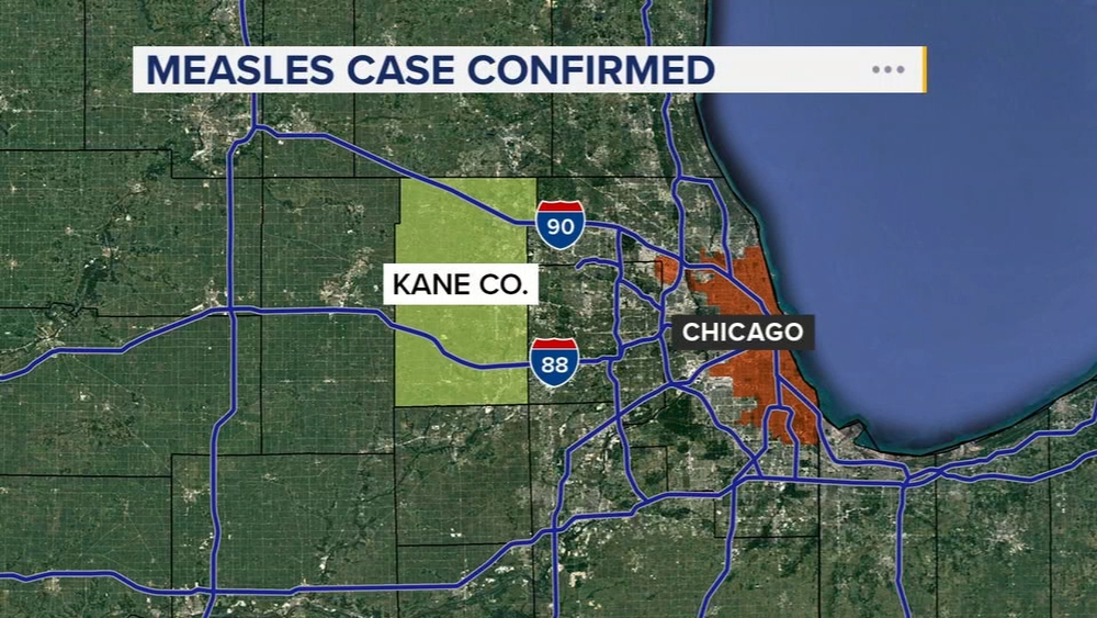 Measles case confirmed in Kane County, health department says