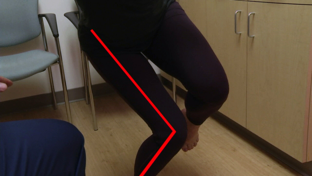 Doctor develops program to reduce ACL tears for female athletes