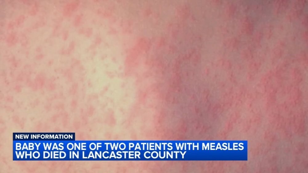 Baby among 2 measles deaths in Lancaster County, Pennsylvania, health officials say