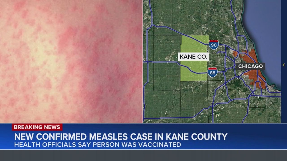 Kane County officials identify 2nd confirmed measles case