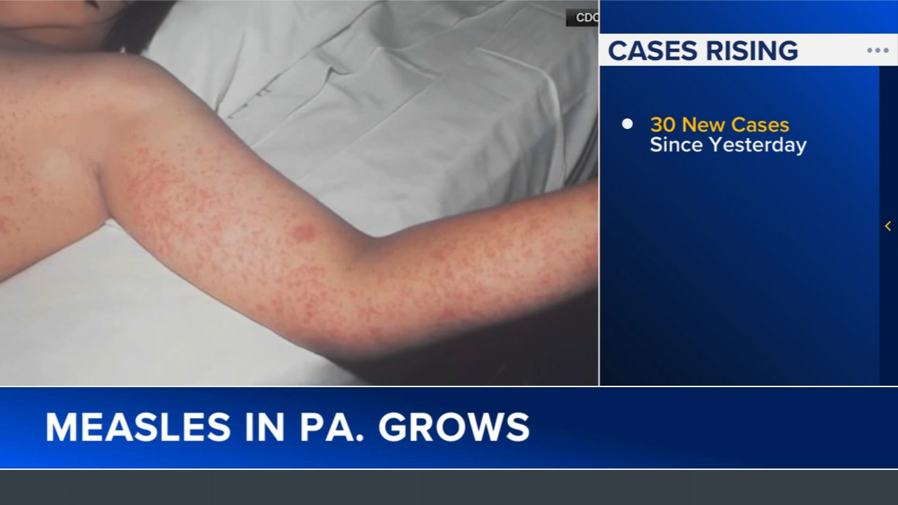 Pennsylvania's measles outbreak grows to 624 cases