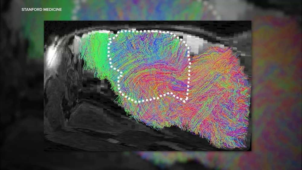 Stanford researchers successfully grow human brain tissue inside mice