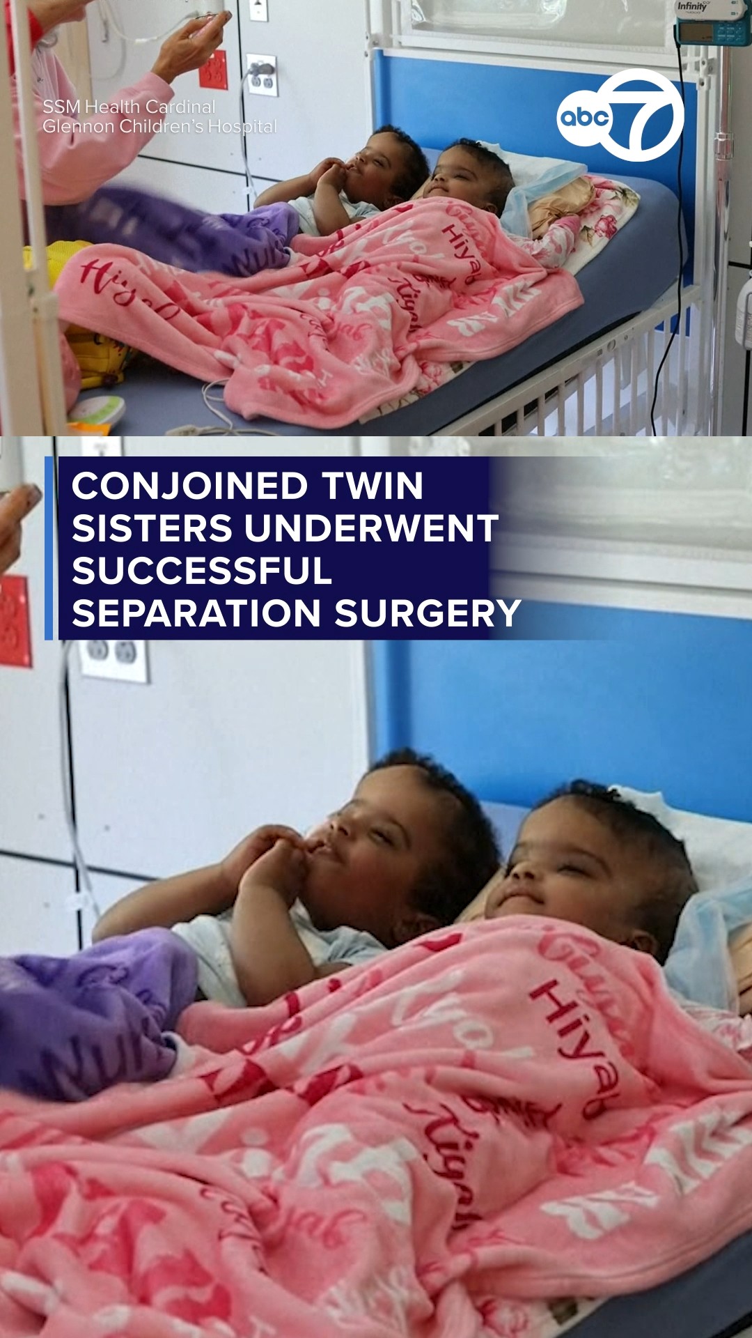 Conjoined twin sisters underwent successful separation surgery