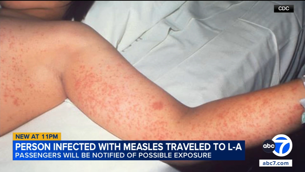 LA Union Station travelers may have been exposed to measles by infected passenger, officials warned