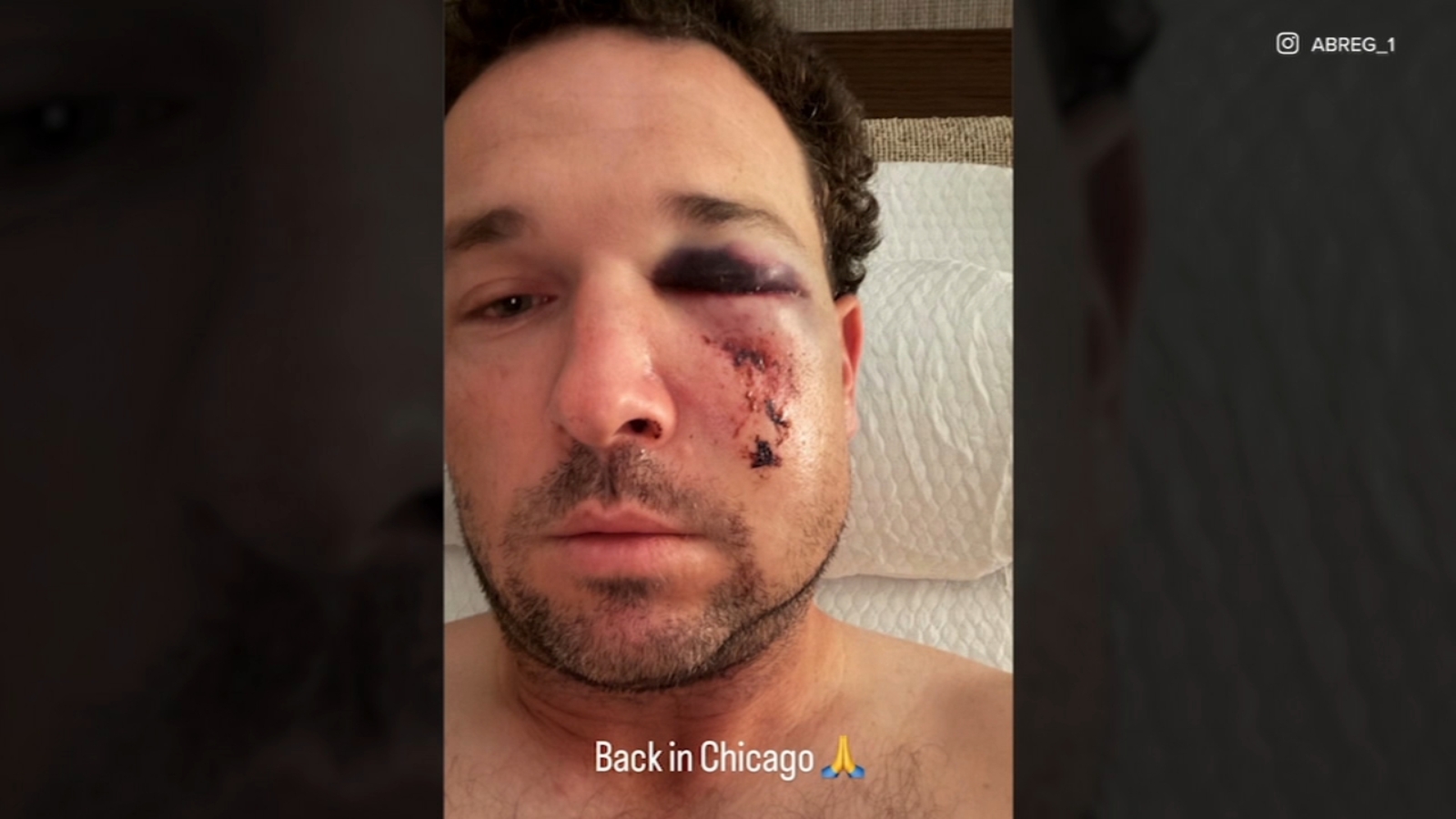 Multiple Fracture Picture Chicago Cubs' Alex Bregman suffers facial fractures from foul ball ...