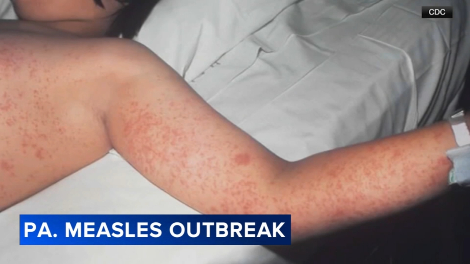 Health officials report 43 new measles cases in Pennsylvania since Monday; state total now topping 800 - 6abc Philadelphia