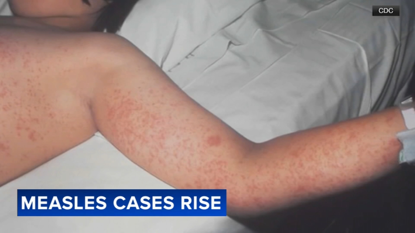 Coverage image for: Measles cases rise as CDC lists first measles-related death; Philly doctor recalls 1991 outbreak