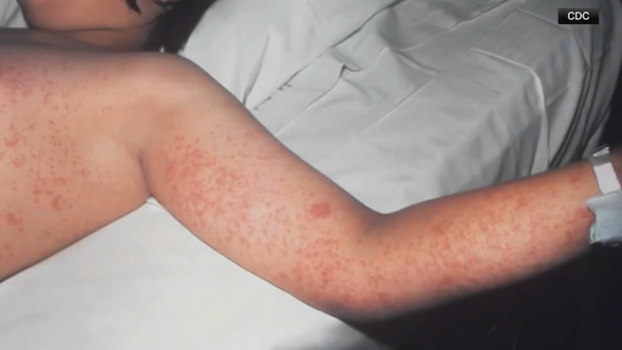 Measles cases surpass 1,000 in Pennsylvania amid state's largest outbreak in decades