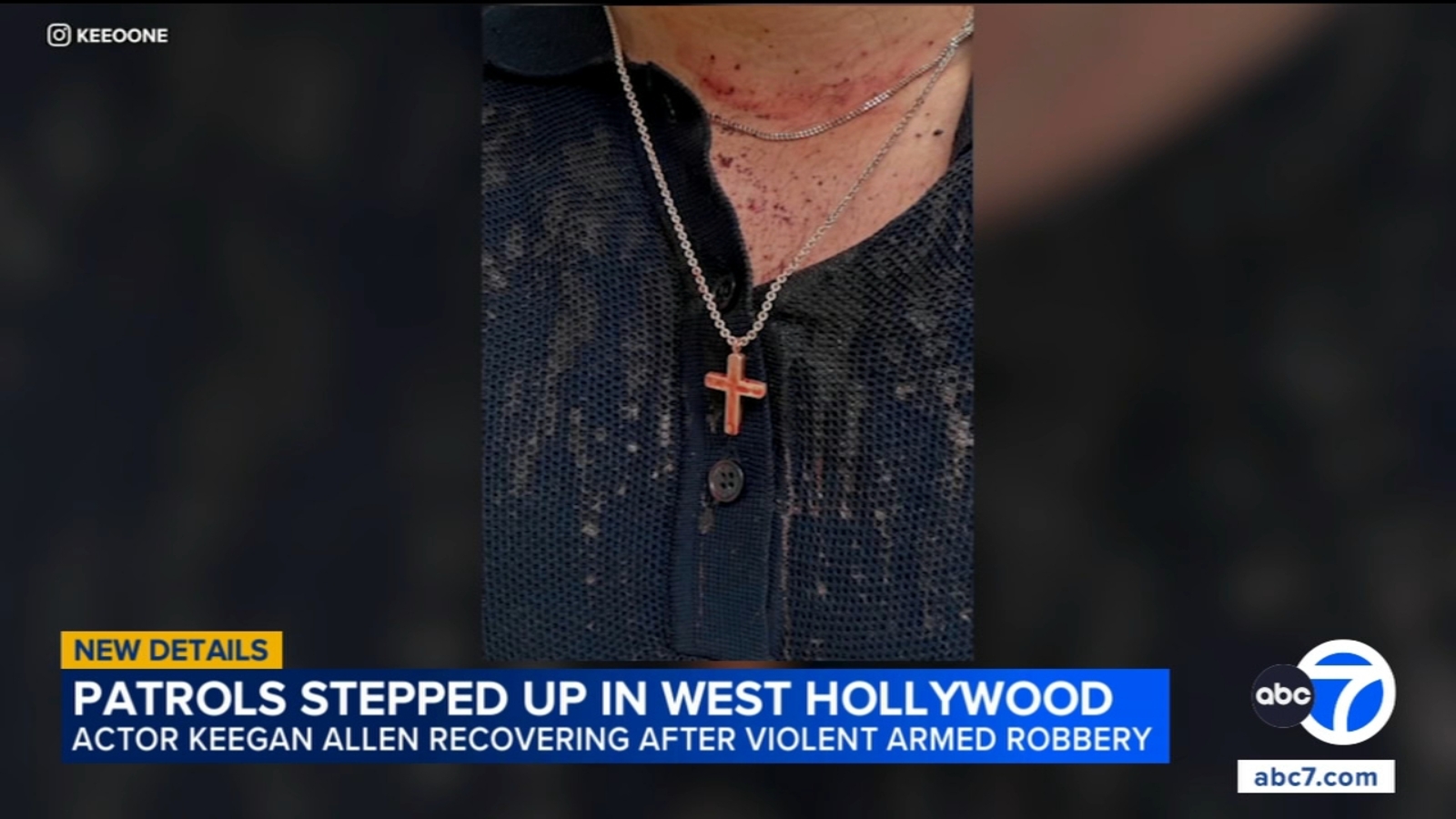 Keegan Allen on the mend, patrols stepped up in West Hollywood after violent armed robbery