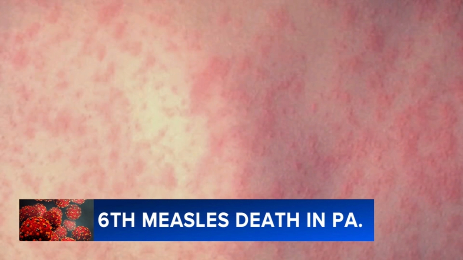 6th measles-related death reported in Pennsylvania; health officials say