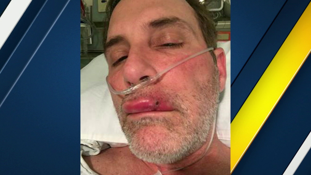 Man sues Beverly Hills spa after contracting MRSA