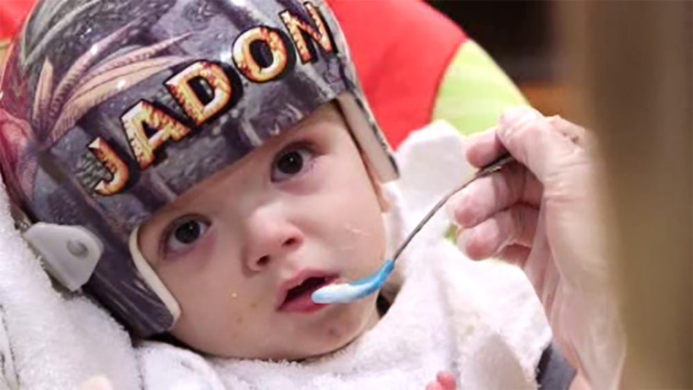 Conjoined twins separated last year continue recovery