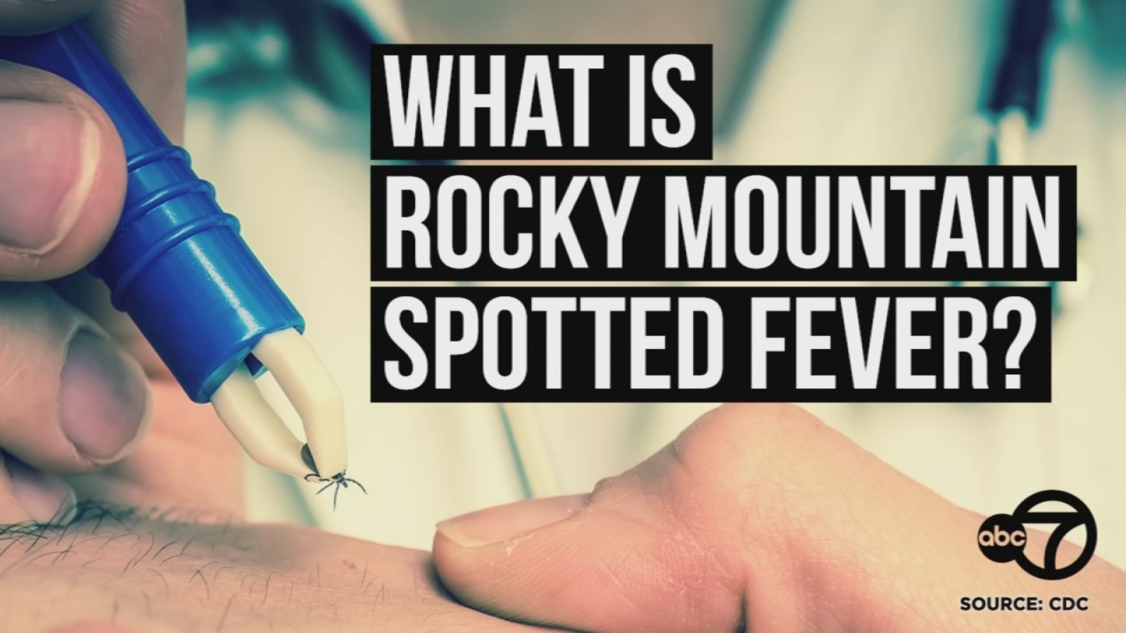What you need to know about the tick-borne illness Rocky Mountain