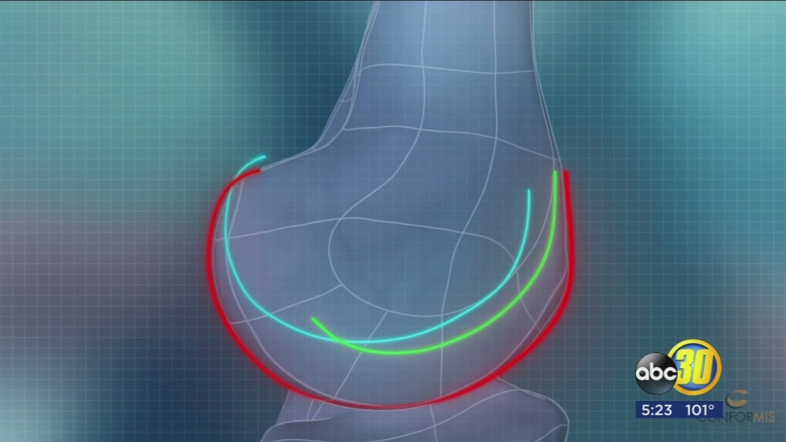 Build Your Own 3D Knee - ABC30 Fresno