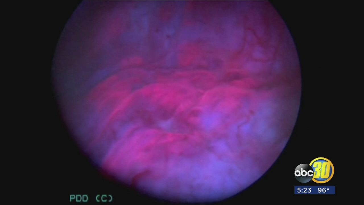 Blue Light Saves Young Bladder Cancer Patient