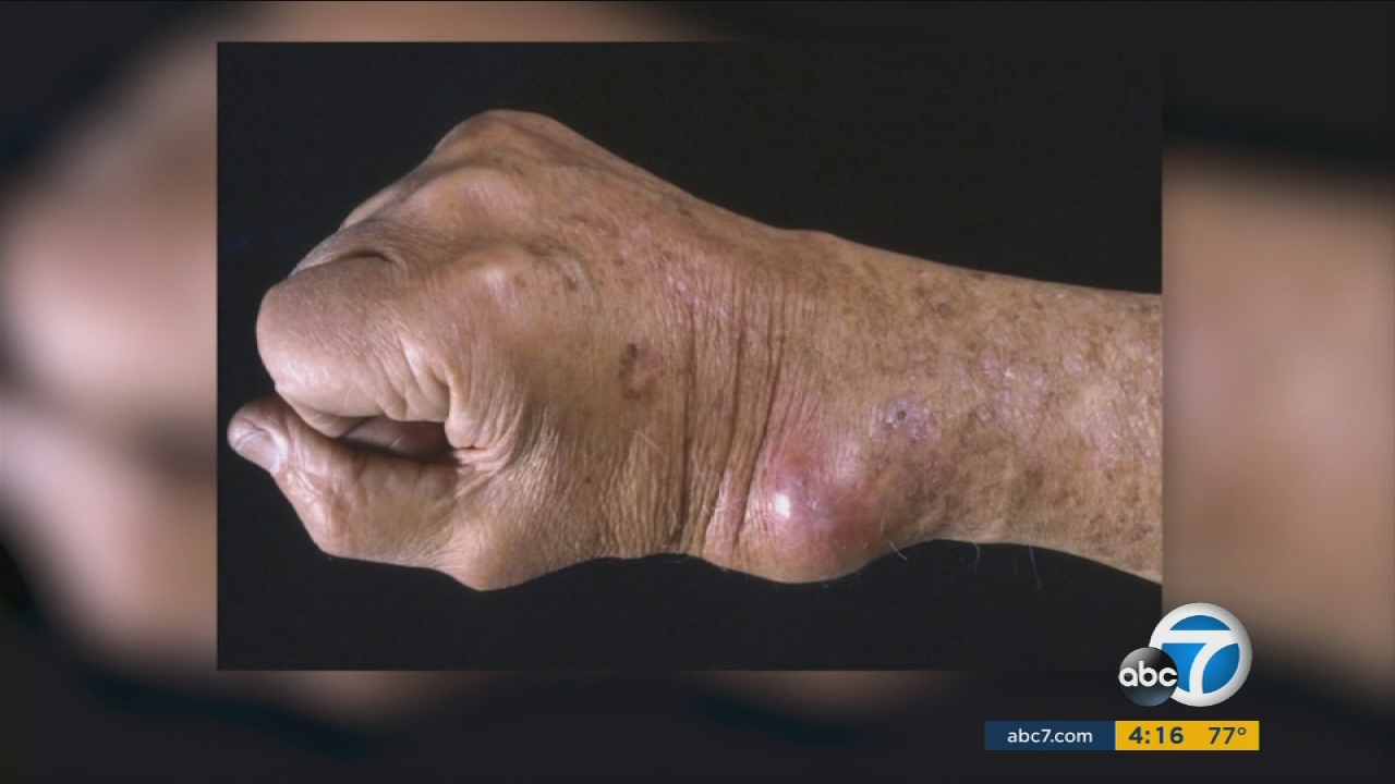 'Valley Fever' on the rise in Los Angeles area