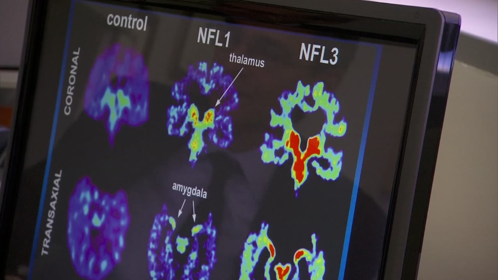 Study finds that 110 of 111 brains from former NFL players contained