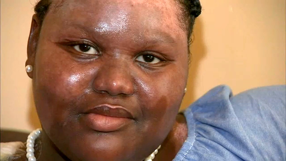 11-year-old girl burned by boiling water during sleepover: 'I can't be angry'