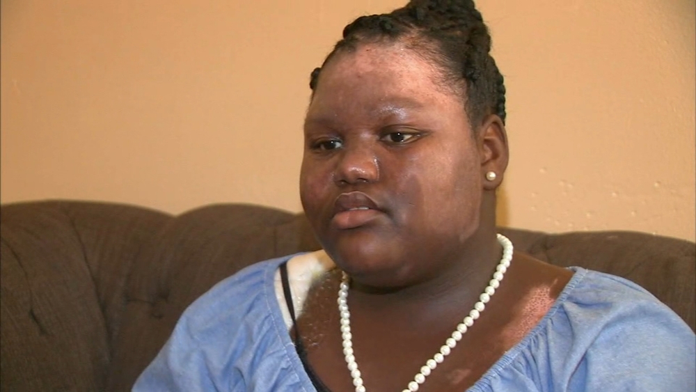 Web extra: Girl talks about being burned by boiling water
