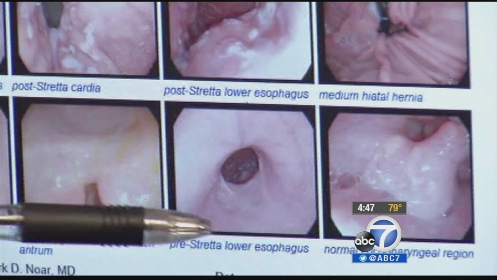 Stretta procedure alleviates pain from GERD ABC7 Los Angeles Stretta procedure alleviates pain from GERD ABC7 Los Angeles