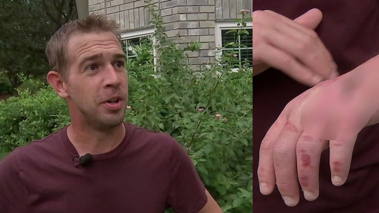 Man fights severe flesh-eating bacteria case after Harvey