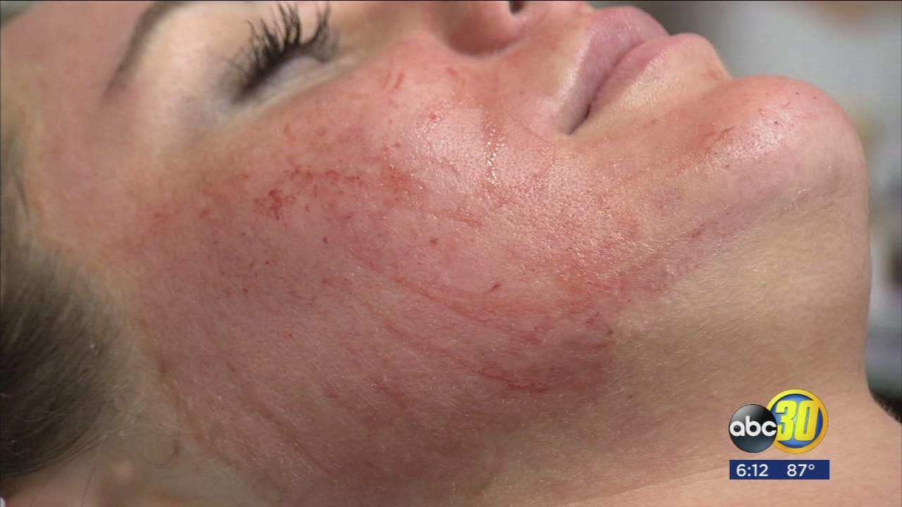Spooky sounding new facial that is a hit with celebrities now available in the Valley