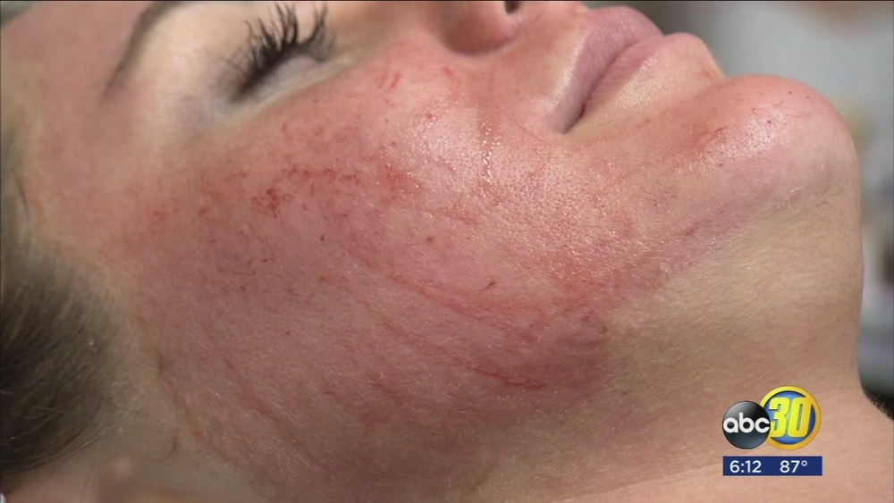 Spooky sounding new facial that is a hit with celebrities now available in the Valley