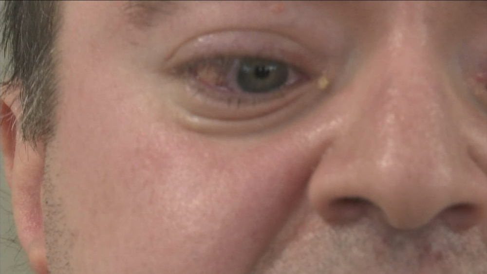 USC-developed retinal implant gives new vision to blind patient