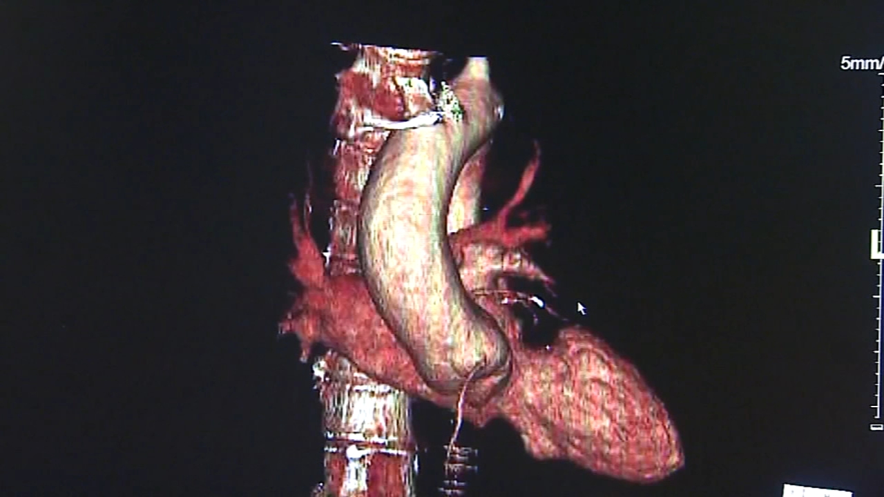Study finds NFL players more likely to have enlarged aorta