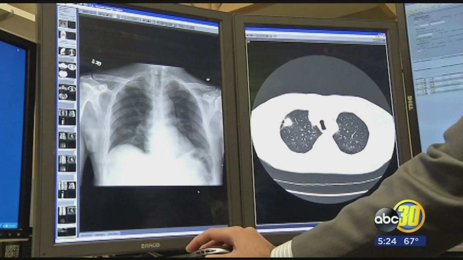 Myths About Lung Cancer