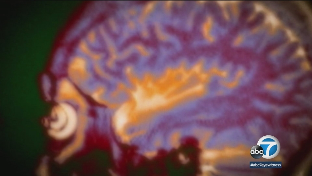 How to recognize the early signs of Alzheimer's disease