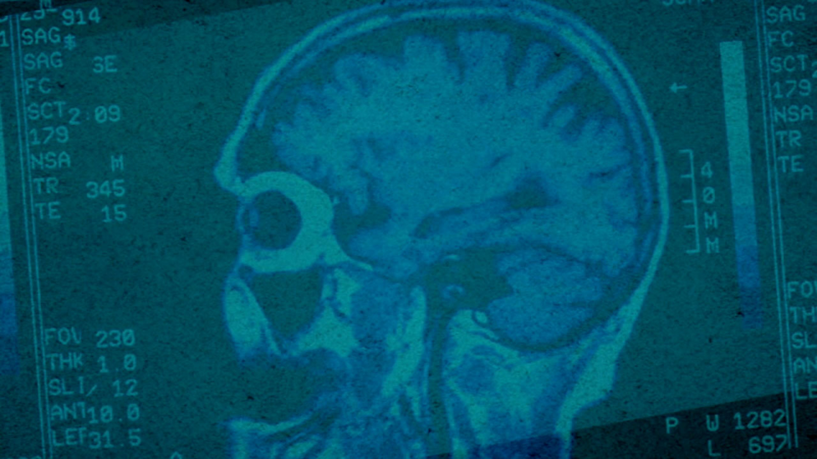 New study finds CTE may also be caused by small, repetitive hits - ABC7