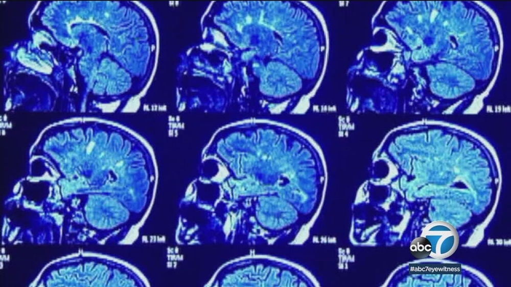 Research looks into why strokes may be deadlier for Asians