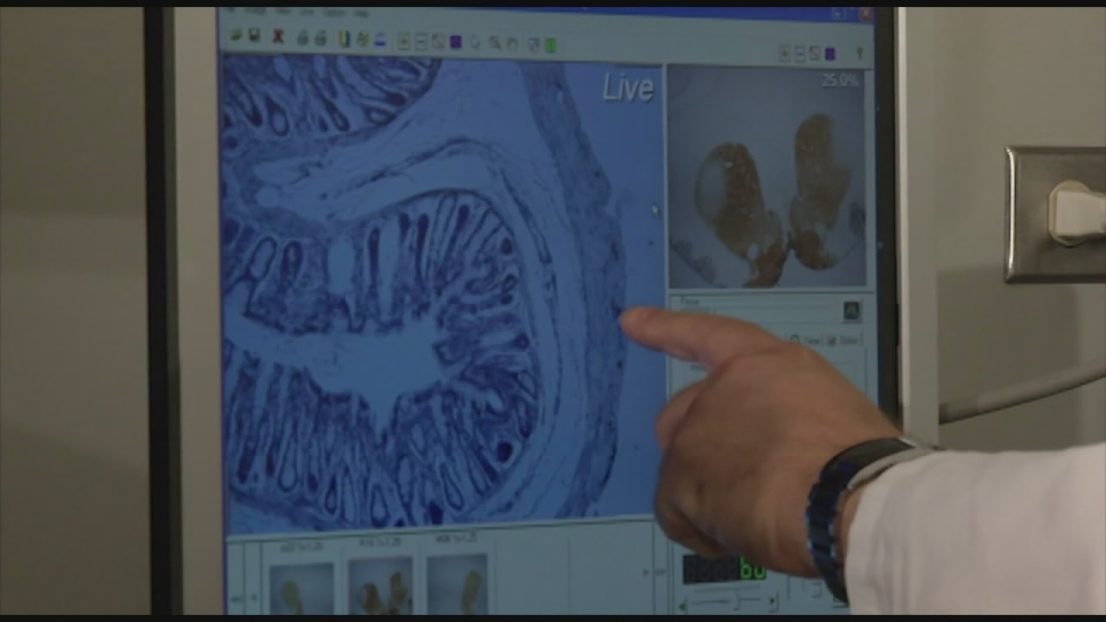 Crohn's Disease Diagnosis Difficult, Treatment Worse? ABC30 Fresno