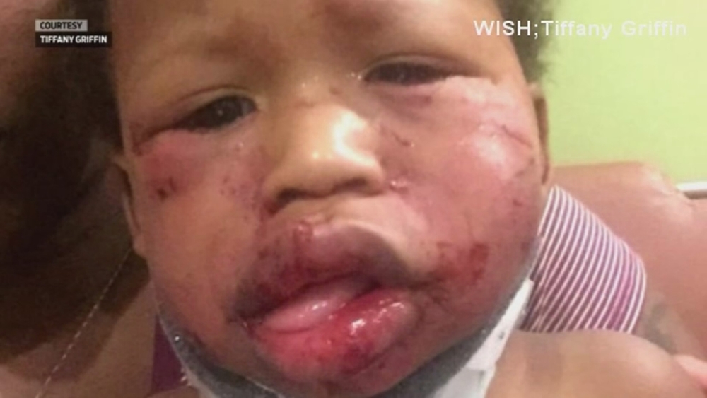 1-year-old apparently beaten at Indiana day care