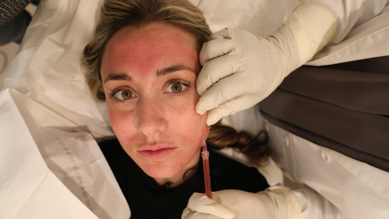 WARNING: Glam Lab tries this bloody vampire facial that pricks your skin with your own blood!