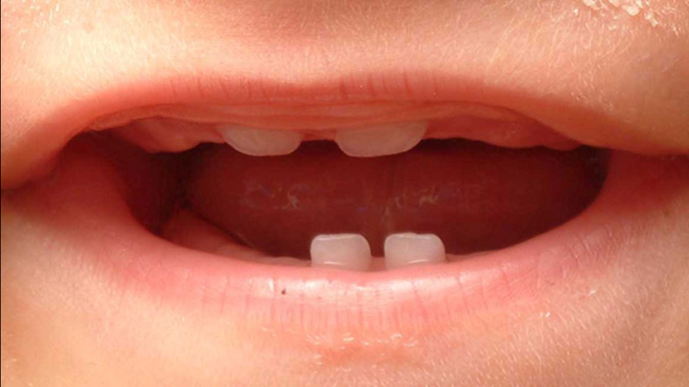 FDA warns teething medicines unsafe, wants them off shelves