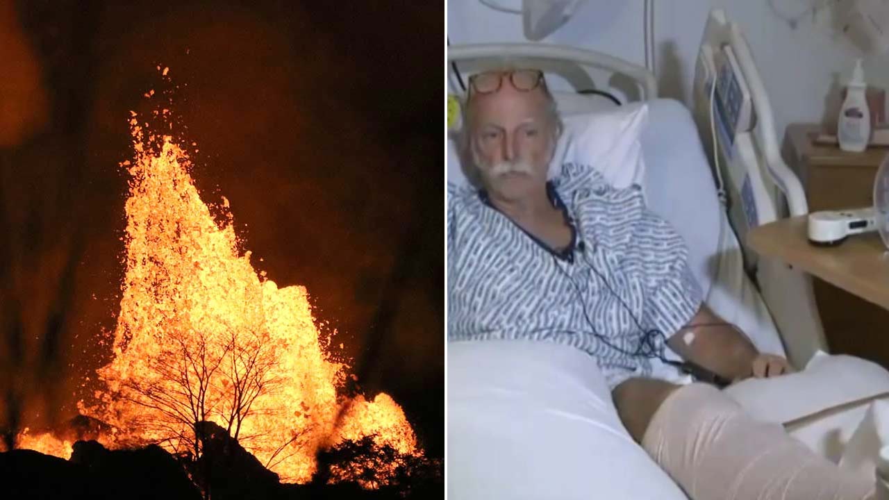 'Lava bomb' shatters leg of SoCal native living in Hawaii