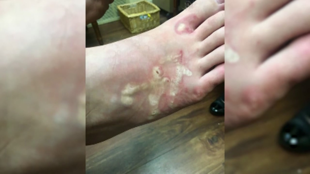 Teen infected with hookworms