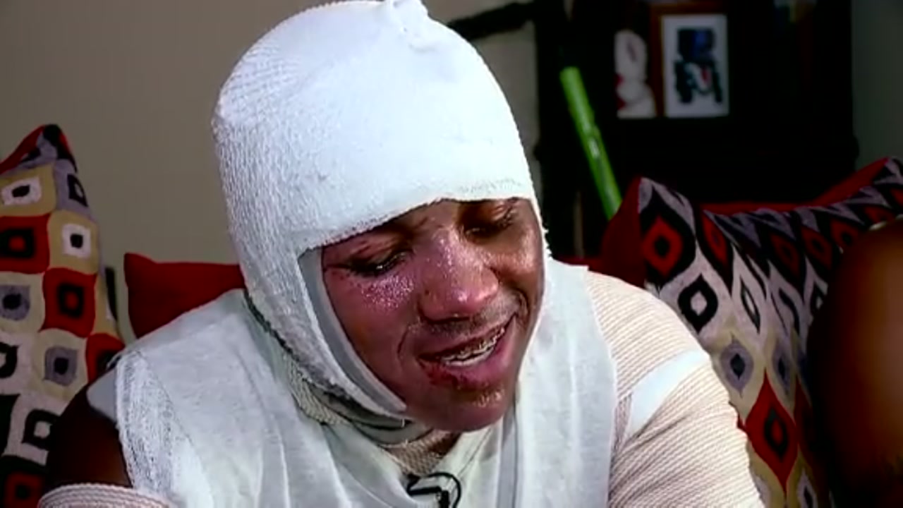 15-year-old severely burned in hot water viral challenge