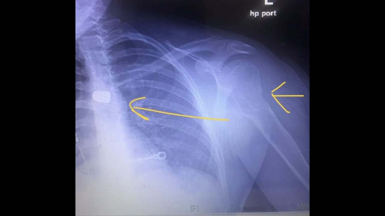 x-ray of victim who was shot in Katy area, shows bullet lodged near heart