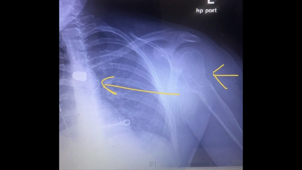 x-ray of victim who was shot in Katy area, shows bullet lodged near heart