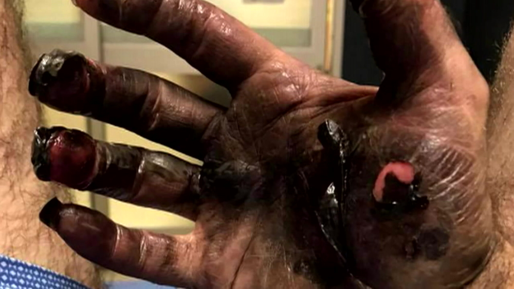 Fort Worth man suffers 3rd degree burns after e-cigarette explodes in his  pocket - ABC13 Houston