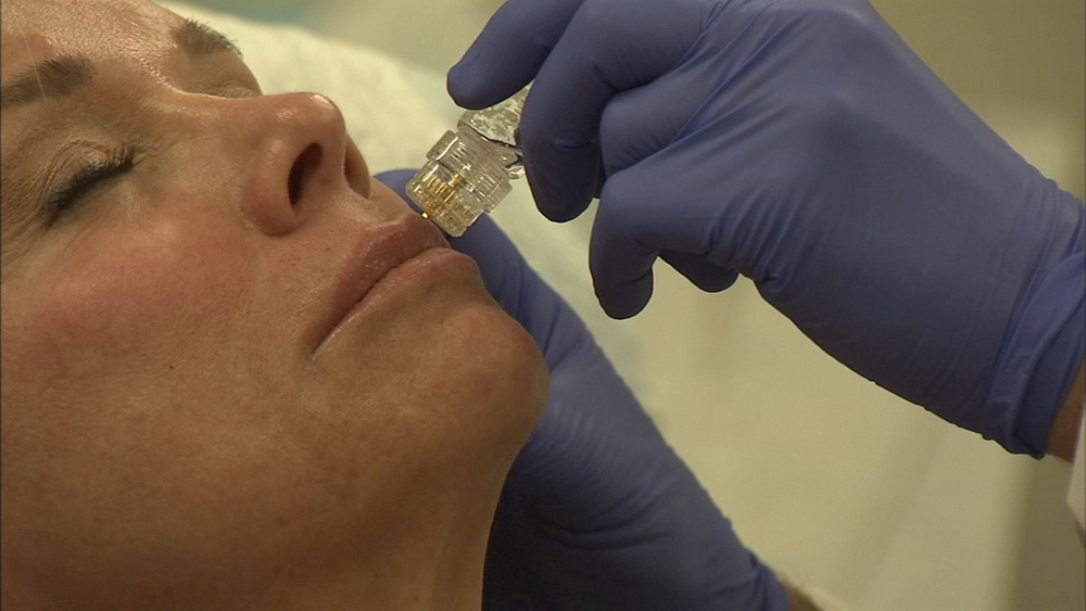 What's the Deal: AquaGold offers a more gentle microneedling procedure