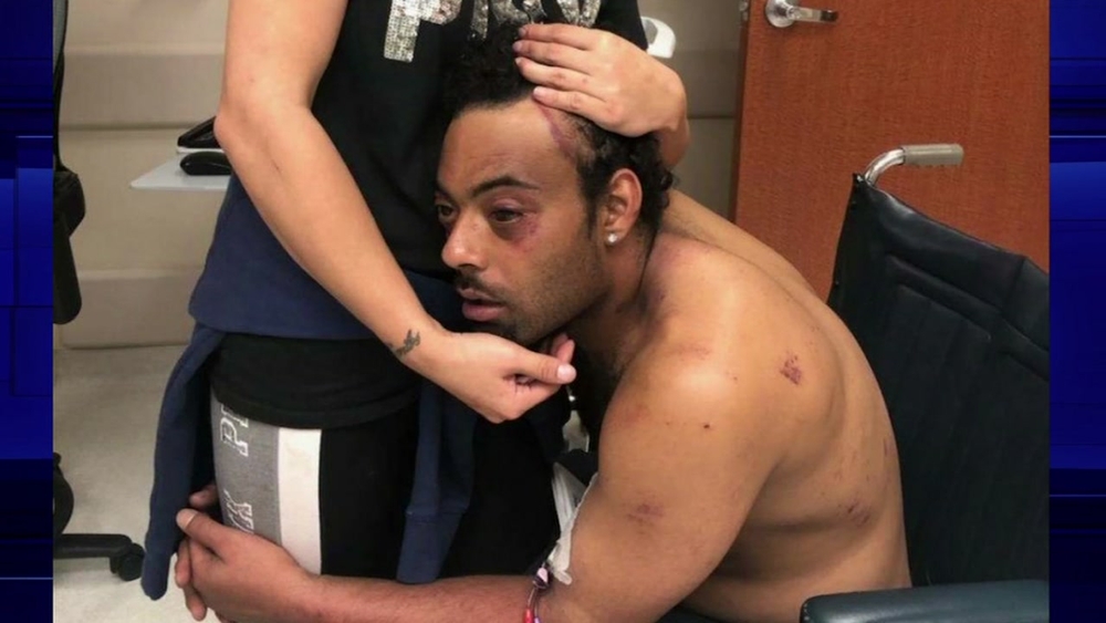 Man with leukemia says Galveston officers beat him.