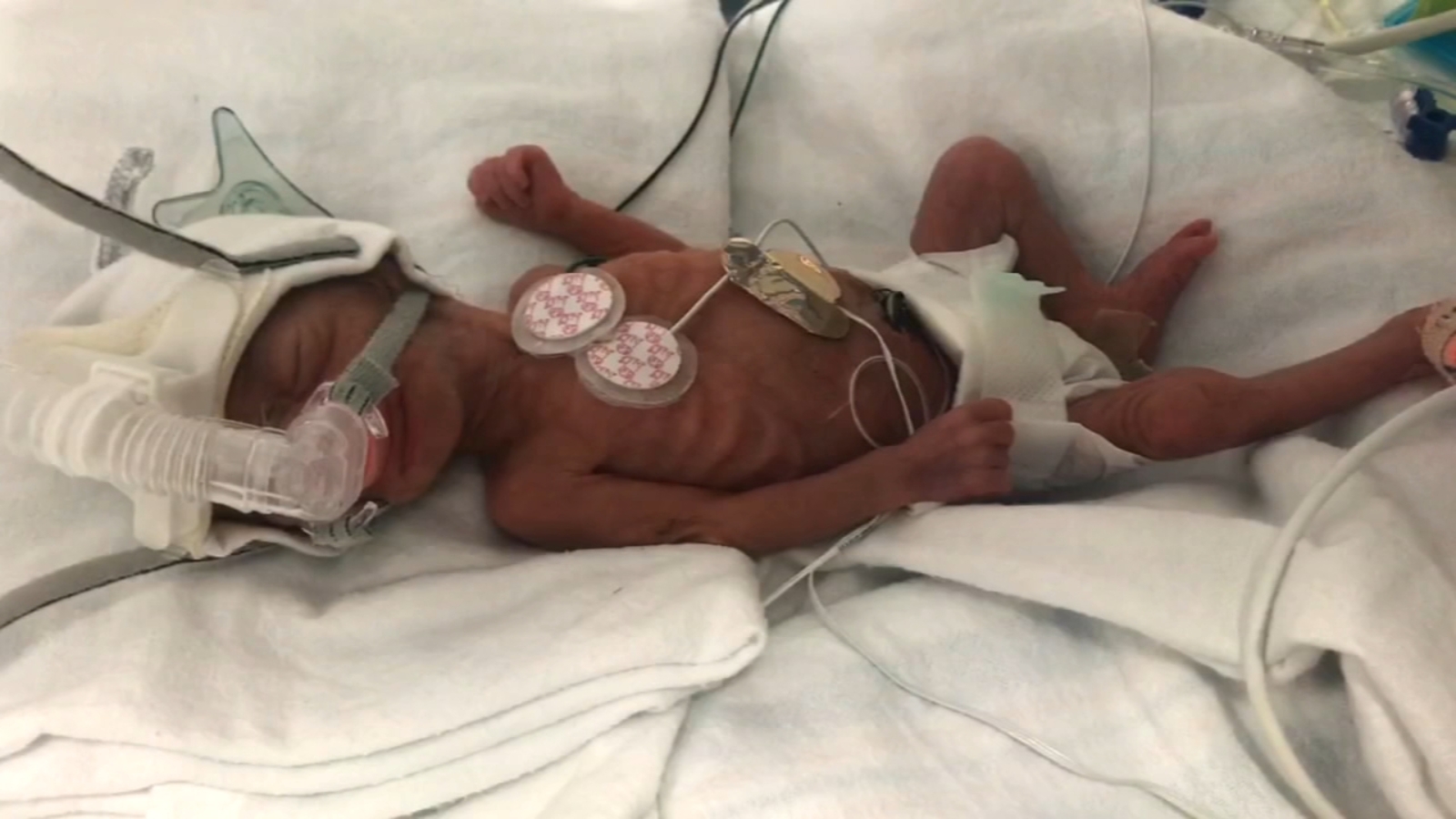 Miracle Baby Smallest child ever born at Nassau University Medical