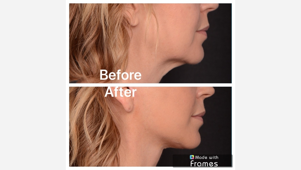 Pioneering face lift technique helps women approaching midlife