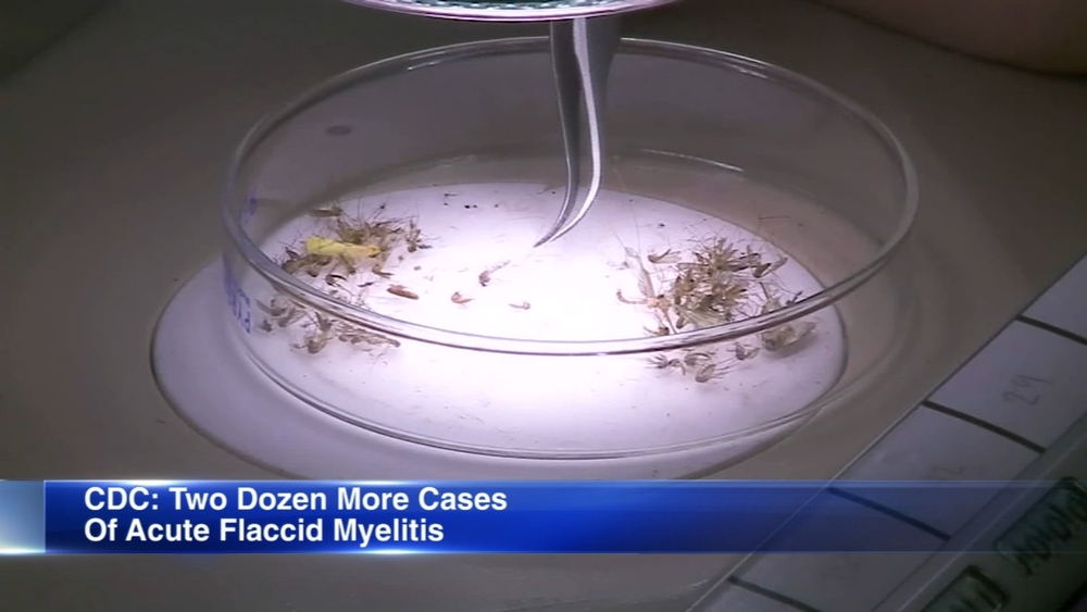 AFM disease: Record count reported for mysterious paralyzing illness